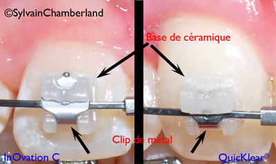 Comparaison QuicKlear In-Ovation C-Dr Chamberland orthodontiste à Québec