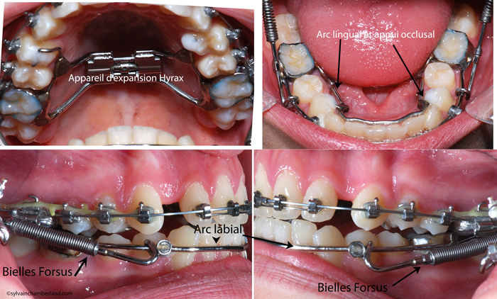 Appareil Xbow (crossbow) pour la correction de malocclusions de classe II-Dr Chamberland orthodontiste à Québec