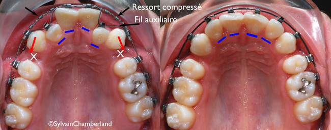 PaPaGe_mecanotherapie-orthodontiste-chamberland-Quebec