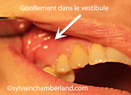 Kyste-vestibulaire-sup-droit-Chamberland-Orthodontiste-a-Quebec
