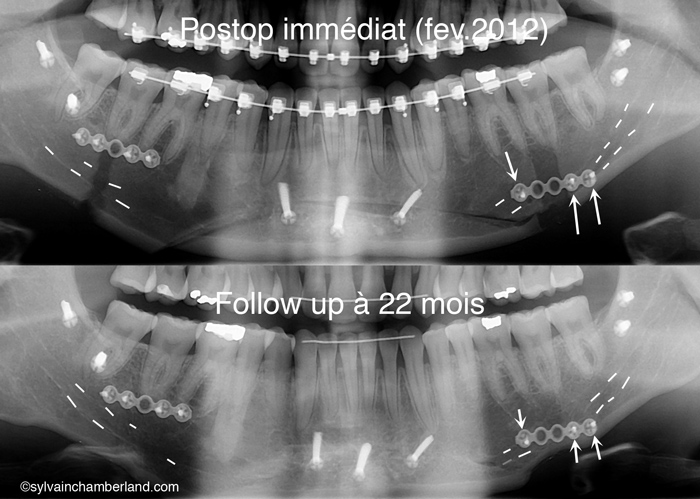 Paresthésie gauche plaque monocorticale-Dr Chamberland orthodontiste à Québec