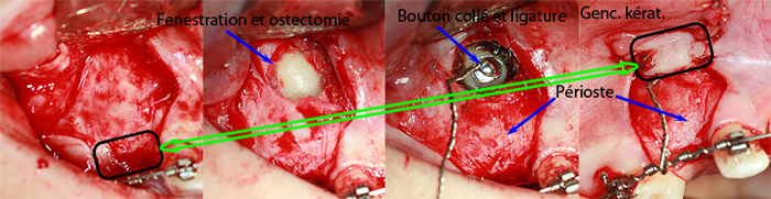 700-Apically-repositioned-flap-for-surgical-exposure-and-ligation-of-impacted-canine-orthodontist-Chamberland-Quebec
