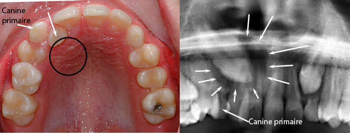 Impacted Teeth Canines Dr Sylvain Chamberland Orthodontiste