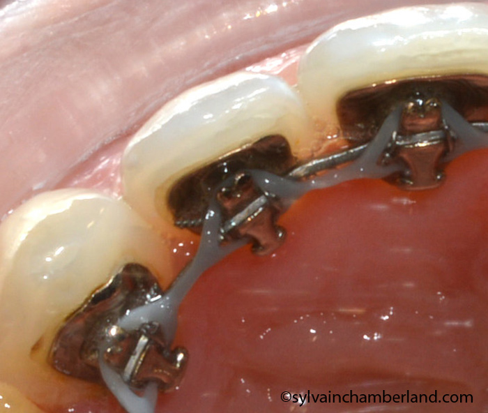 Incognito gouttière à insertion verticale-Dr Chamberland orthodontiste à Québec Incognito gouttière à insertion verticale-Dr Chamberland orthodontiste à Québec
