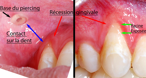 [تصویر:  Piercing-labial-et-recession-gingival-or...Quebec.jpg]