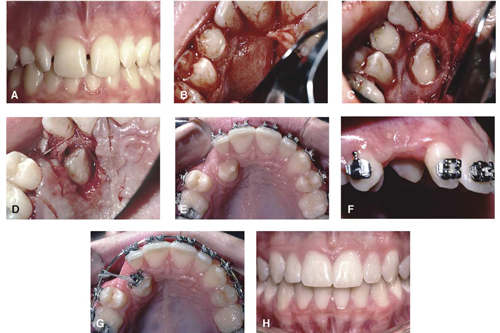 Technique Chirurgicale Dr Sylvain Chamberland Orthodontiste