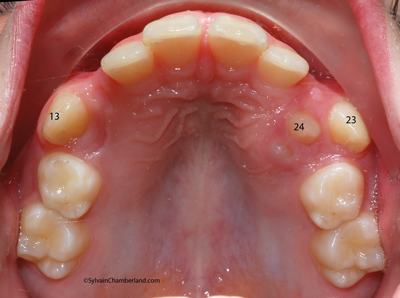 Transposition-canine-premolaire-chamberland-orthodontiste-quebec-RaBo-09-07-2012