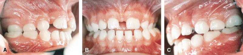 Prolonged-pacifier-habit-orthodontist-Chamberland-Quebec