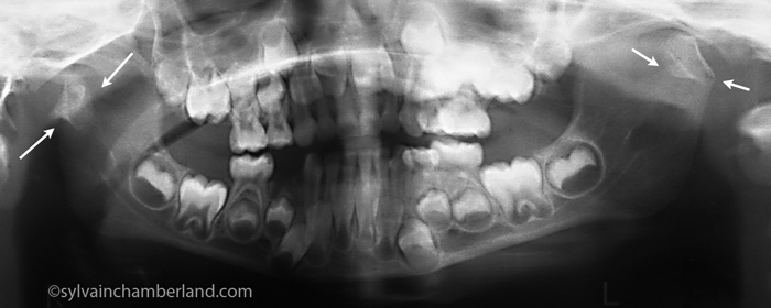 imagerie atm. aide diagn. troubles cranio-mandibu.