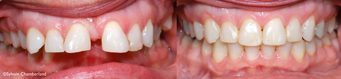 LoDeCh-initial-final orthodontiste-Chamberland-Quebec