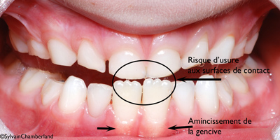 Facette-d'usure-et-risque-de-récession-gingivale-MaLaBe-iof2-07102010-orthodontiste-Chamberland-Québec