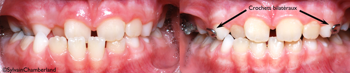 JePla-crochet-intraoral-pour-masque-de-protraction-orthodontiste-Chamberland-Québec