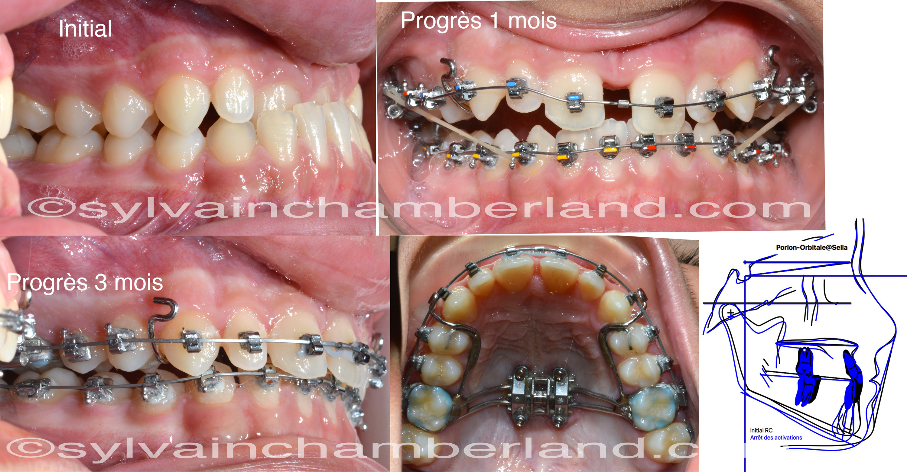 Aperçu Macro De La Bouche Ouverte Des Dents De La Langue Et Des Appareils  Dentaires En