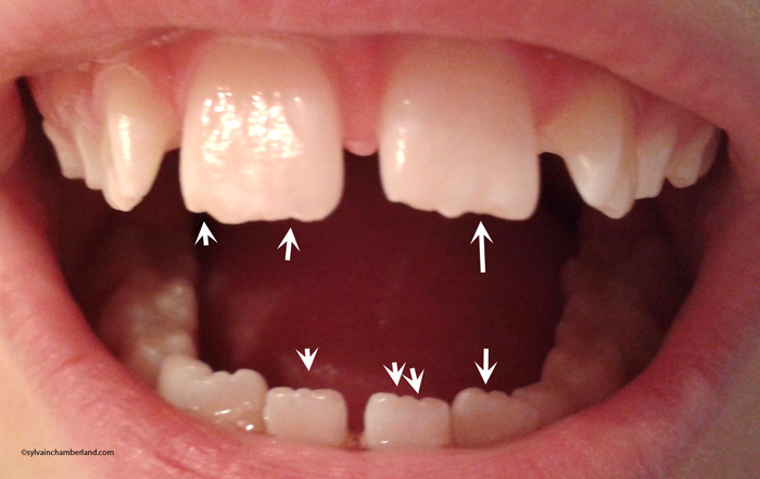 attrition-versus-erosion-dentaire-chamberland-orthodontiste-a-quebec