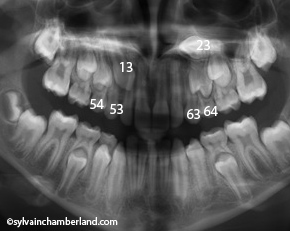 High-impacted-canine-Chamberland-orthodontiste-a-Quebec