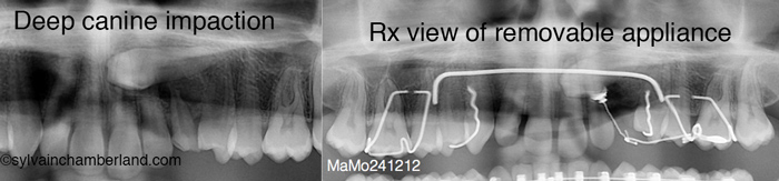 Removable-appliance_cantilever-spring-for-impacted-canine-Chamberland-Orthodontiste-à-Quebec-M-A-Mor