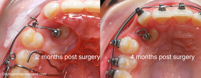 Traction-canine-removable-appliance-and-cantilever-spring-Chamberland-Orthodontiste-Quebec