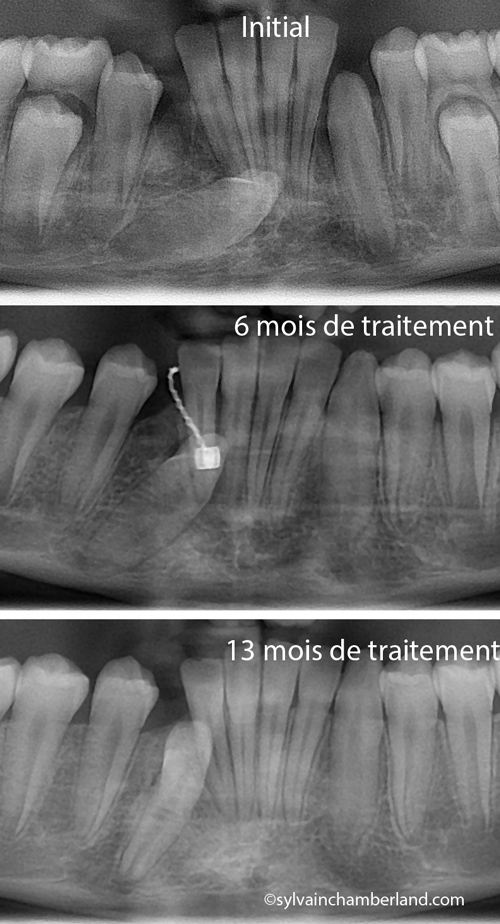 Canine-mandibulaire-incluse-ViTa-Chamberland-orthodontiste-a-Quebec
