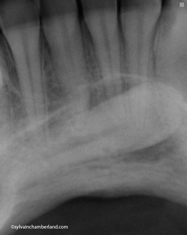 Mandibular-impacted-Canine-Chamberland-Orthodontiste-a-Quebec