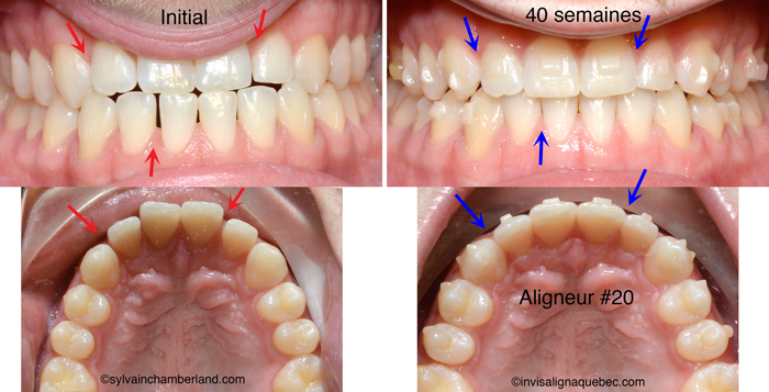 Classe III traitement Invisalign-Dr Chamberland orthodontiste à Québec