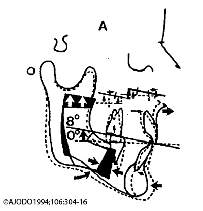 Alteration-du-plan-occlusal-Wolford-Chemello-and-Hilliard