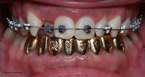 Grillz iof JoDr SPEED bracket-Dr Chamberland orthodontist in Quebec City