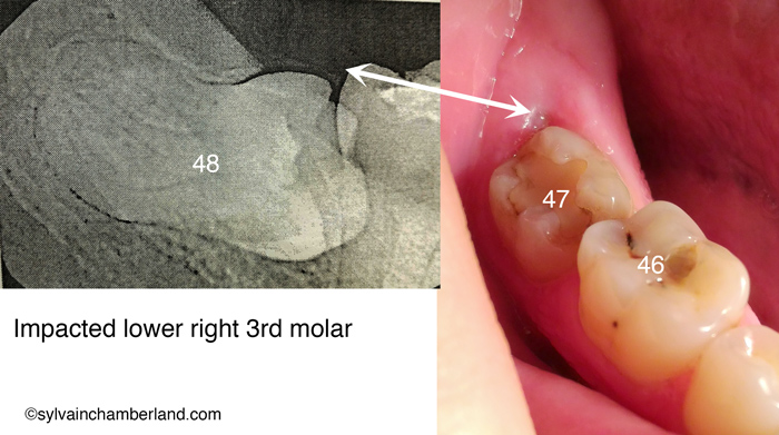 Impacted-lower-3rd-molar-from-russia-Chamberland-Orthodontiste-a-Quebec