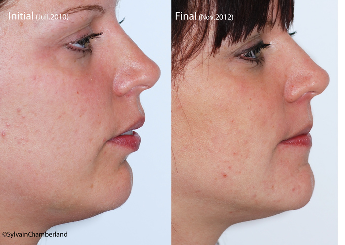 JB-profil-initial-final-orthodontiste-Chamberland-Quebec
