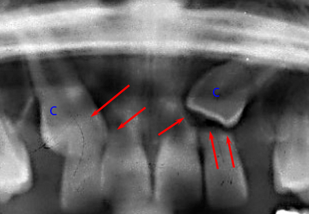 Resorption of permanent lateral incisors caused by impacted canines
