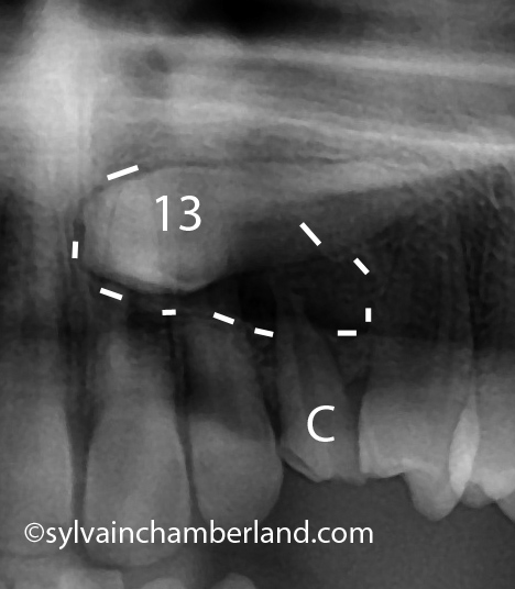 Kyste dentigère ou folliculaire Lésion-apicale-canine-primaire-et-kyste-folliculaire-canine-incluse-Chamberland-orthodontiste-Québec