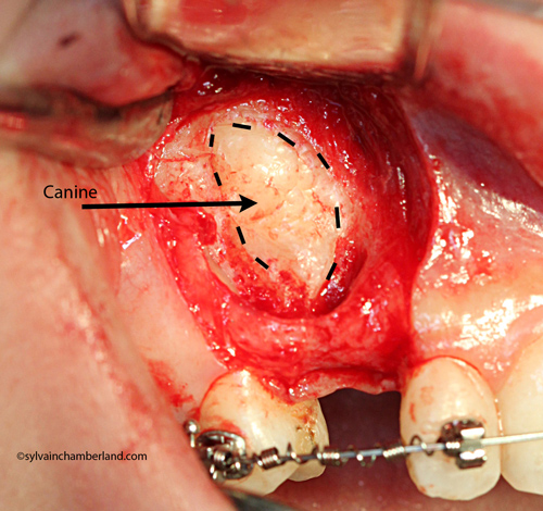 ankylosis-of-impacted-canine-_13_Chamberland-orthodontist-Quebec