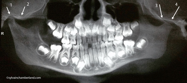 Panoramic-fracture-condyle-gauche-Chamberland-Orthodontiste-Quebec