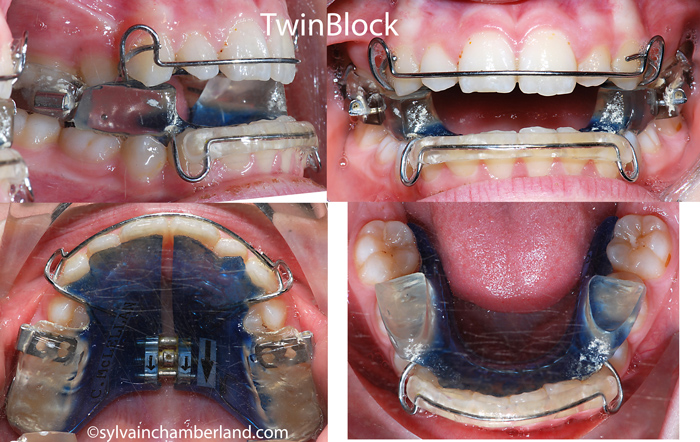 Twinblock-Chamberland-Orthodontiste-a-Quebec