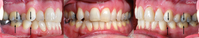 Initial malocclusion. The black arrows indicate a Class I left and right canine and left molar relationship. On the right, the Class II molar relationship is of about 2 mm.