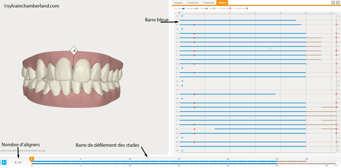Stades de traitement Invisalign®. L'algorithme a calculé qu'il faudra 28 aligners pour les dents supérieures et 31 pour les dents inférieures.