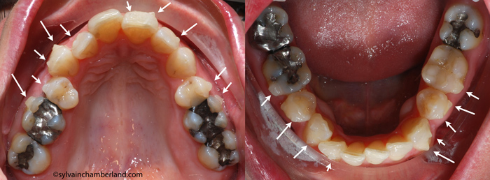 Attachments bonded for Invisalign® trays