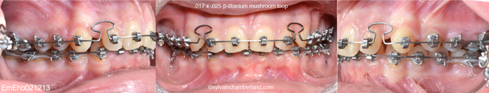 Progression at 43 weeks 17x25 wire mushroom loop-Dr Chamberland orthodontist in Quebec City