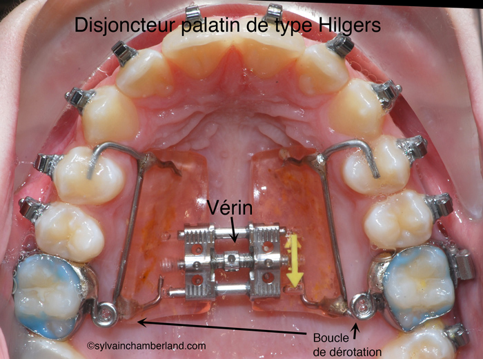 Appareil d'expansion Hilgers disjoncteur palatin-Dr Chamberland orthodontiste à Québec
