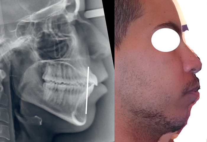 landois-bimax-protrusion-chamberland-orthodontsite-a-quebec