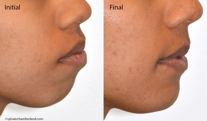 protrusion-bimaxillaire-et-exo-de-4-pm1-chamberland-orthodontiste-a-quebec
