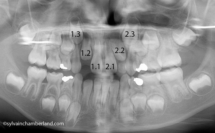 Dental-age-7-LeGui-Chamberland-Orthodontiste-a-Quebec