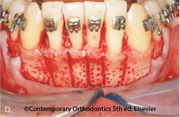 Corticotomy and rapid orthodontics Dr Sylvain Corticotomy and rapid orthodontics Dr Sylvain