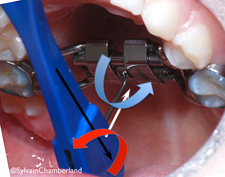 3-Comment activer l'appareil d'expansion étape 3-Dr Chamberland orthodontiste à Québec