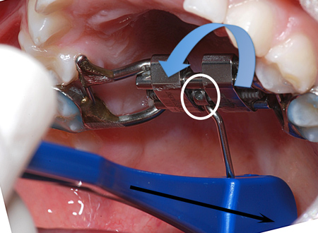 4-Comment activer l'appareil d'expansion étape 4-Dr Chamberland orthodontiste à Québec