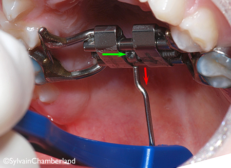 5-Comment activer l'appareil d'expansion étape 5-Dr Chamberland orthodontiste à Québec