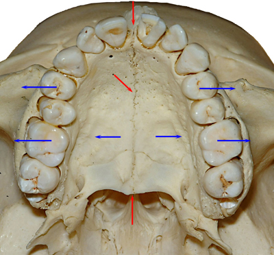 Vue occlusale du maxillaire supérieur suture intermaxillaire et interpalatine-Dr Chamberland orthodontiste à Québec