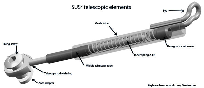 SUS2 telescopic elements-Dr Chamberland orthodontist in Quebec City