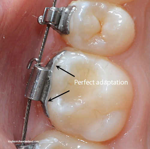16 convertible tube and HG tube perfect adaptation on the tooth-Dr Chamberland orthodontist in Quebec City