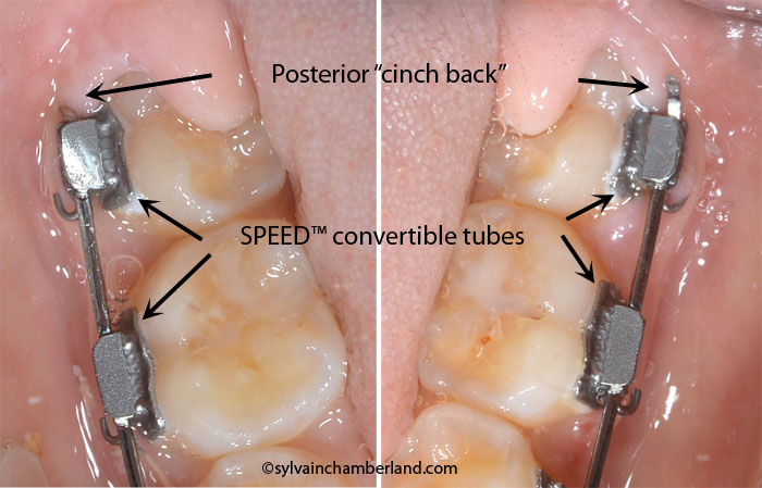 Convertible tube and posterior cinch back-Dr Chamberland orthodontist in Quebec City