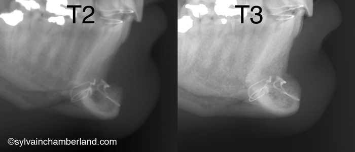 Génioplastie